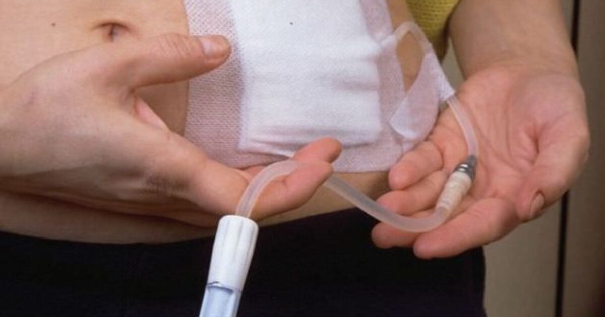 Peritoneal Dialysis
